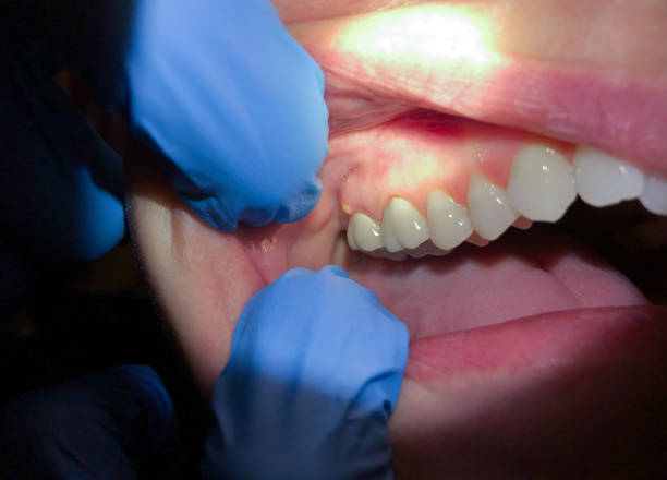 Best Lost Filling or Crown Replacement in Trenton, FL